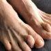 6 Symptoms of Hammertoe